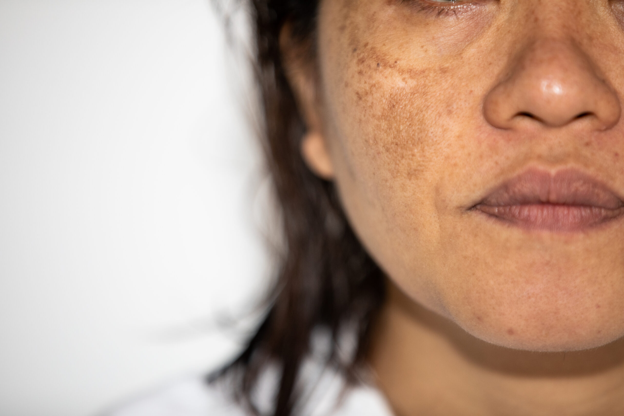 Treating Hyperpigmentation with Topicals - Aesthetics Journal